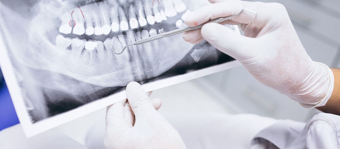 tratamientos-para-recuperar-piezas-dentales-implantes