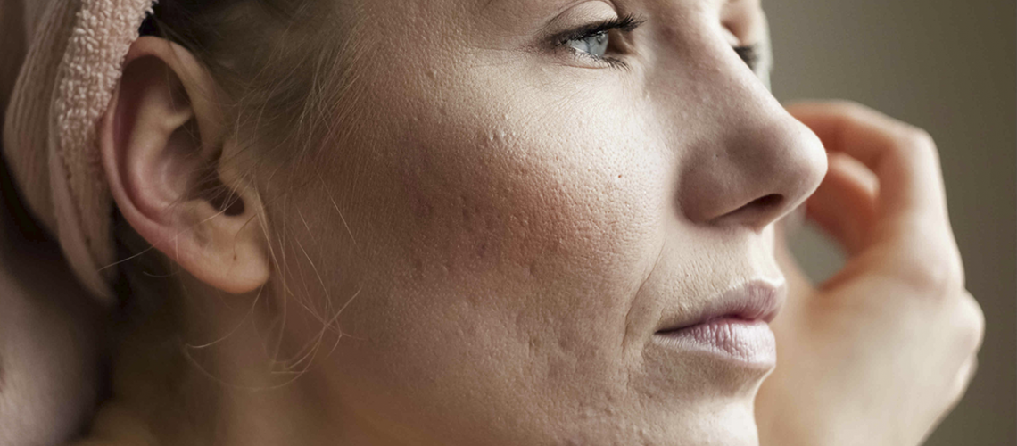 4. Haz desaparecer las cicatrices del acne