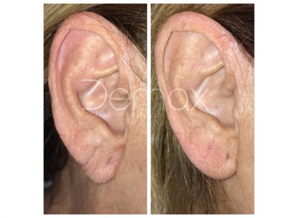 Ácido Hialurónico para envejecimiento del lóbulo de la oreja